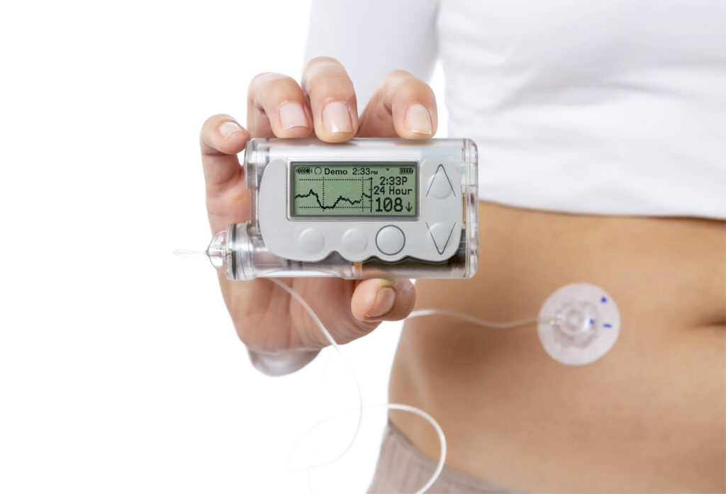 Mit einer Insulinpumpe können chronisch Kranke ihre Behandlung optimal steuern. Bild: click_and_photo - stock.adobe.com